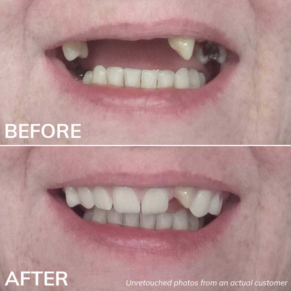 Before and After Photos with the Ultimate Denturas Kit