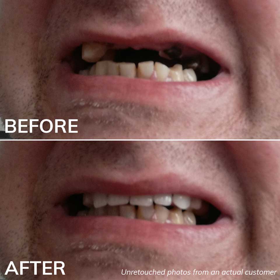 Before and After Photos with the Ultimate Denturas Kit