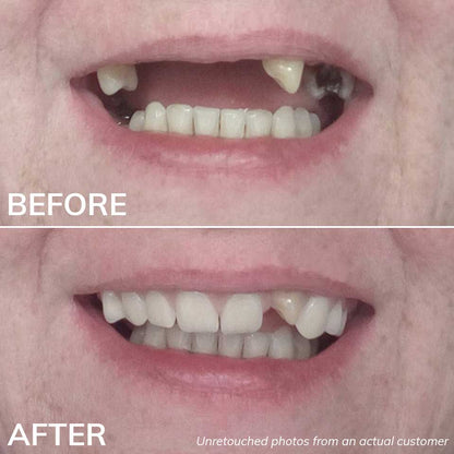 Before and After Photos with the Ultimate Denturas Kit